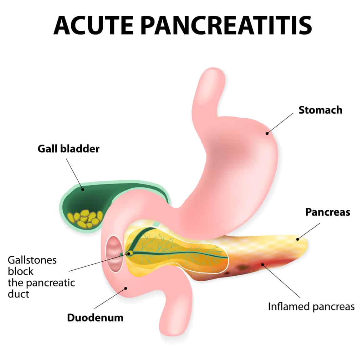 Acute pancreatitis is an inflammation of the pancreas. Gallstones block the flow of pancreatic juices into the duodenum. Digestive enzymes become active in pancreas, where they destroy healthy tissue.