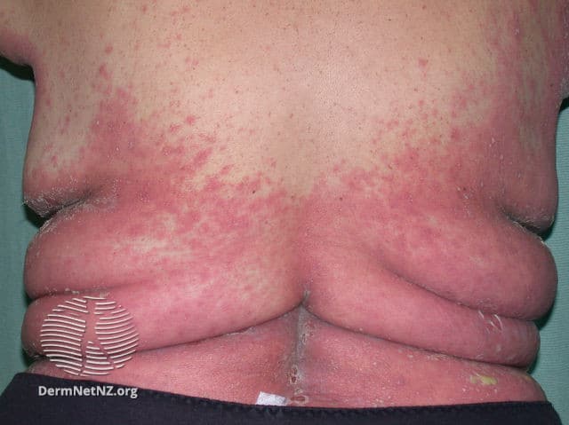Generalized pustular psoriasis; red area covering the lower back of a man