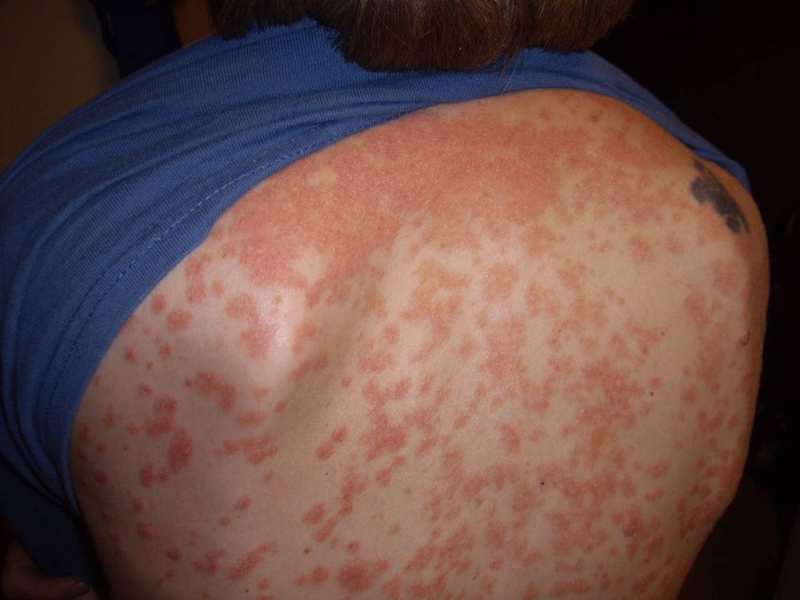 Guttate psoriasis diagnosed in a 30 year old female with elevated ASO, treatment course unspecified.
