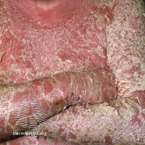 Erythrodermic psoriasis; scaly red patches all over body