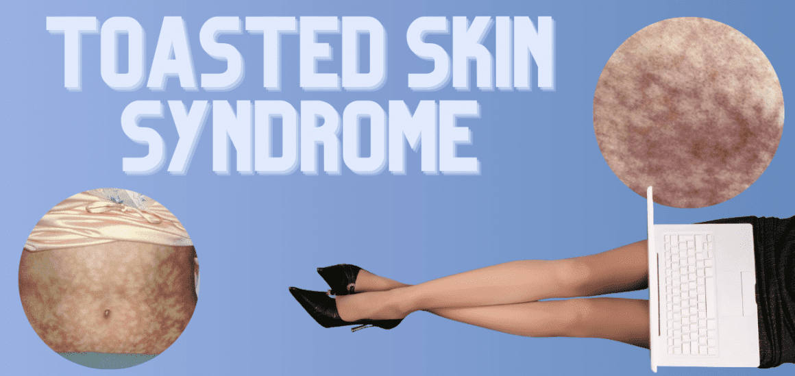 Toasted Skin Syndrome