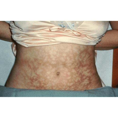 Toasted Skin Syndrome On Stomach