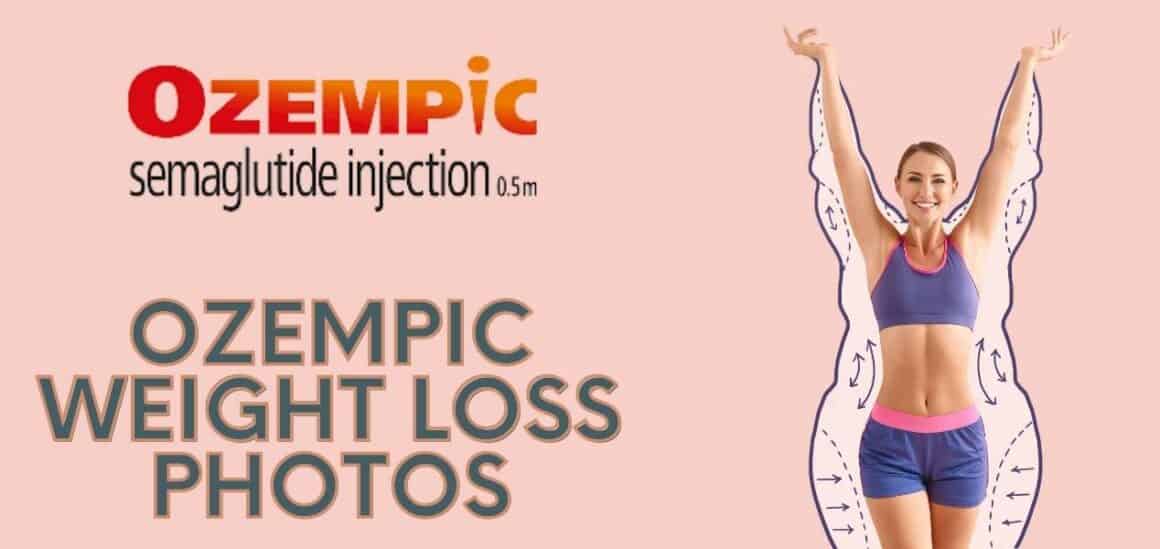 Ozempic Weight Loss Before And After Pictures