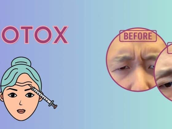 Botox before and after pictures