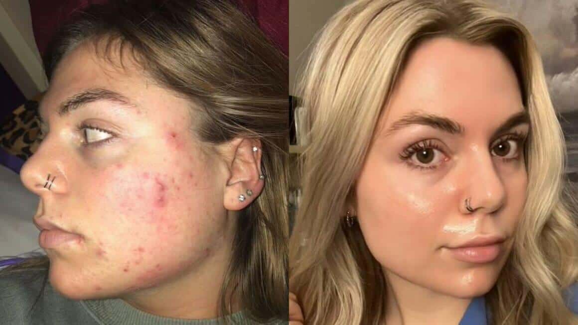 Tretinoin Before And After 