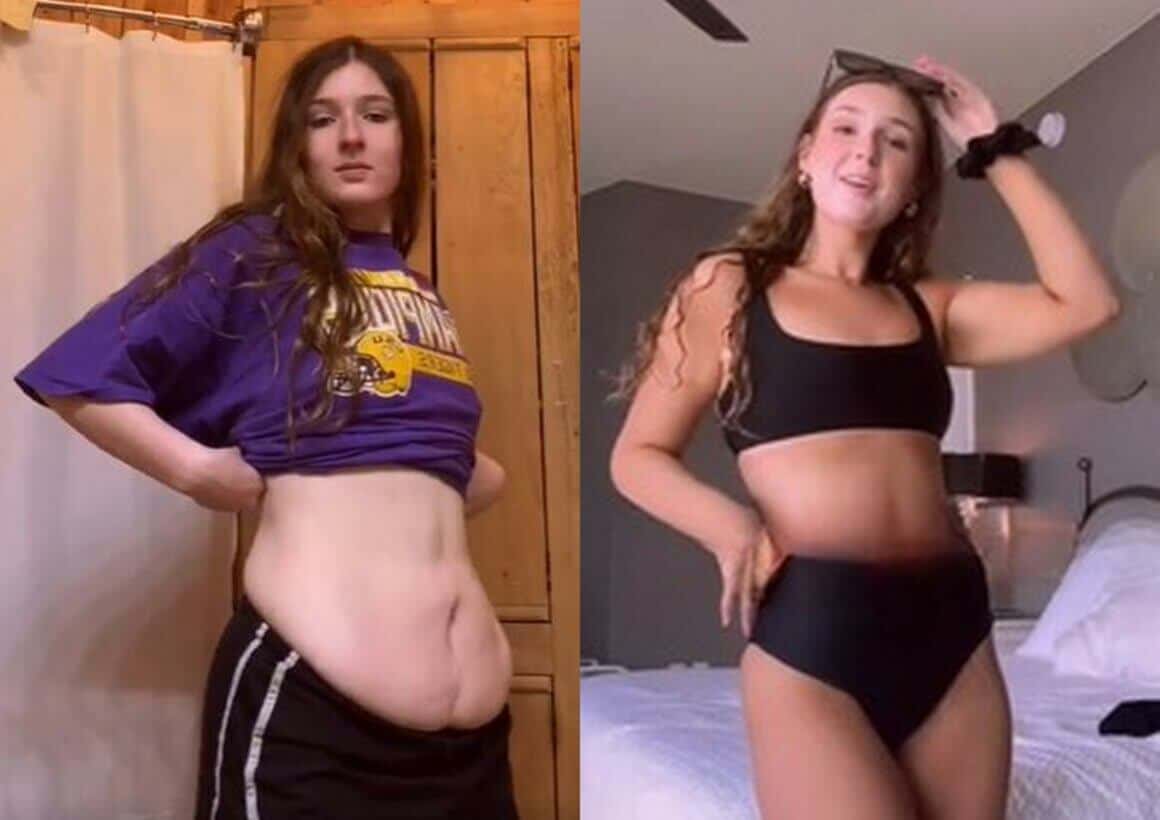Tummy Tuck Before And After 80lb weight loss