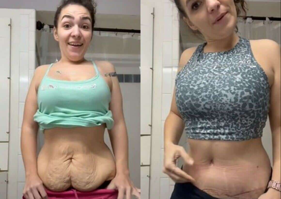 Tummy Tuck Before And After 20lbs of skin removed