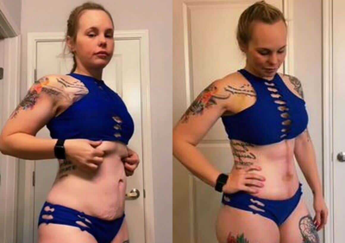 Tummy Tuck Before And After 130lbs weight loss