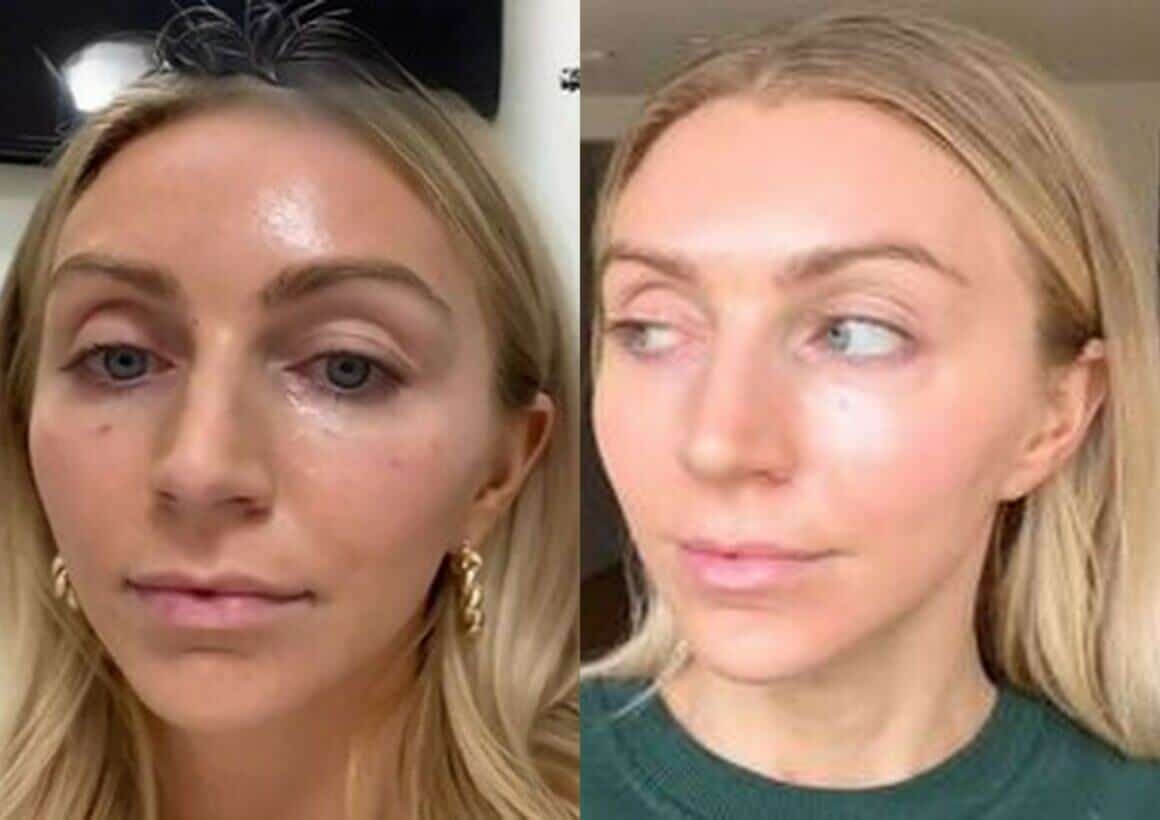 Chemical Peel Before And After 6 days