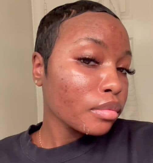day 1 after microneedling