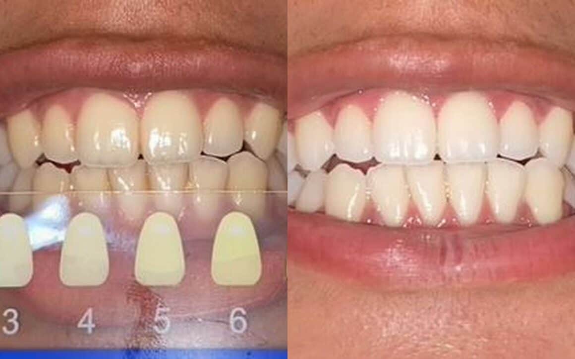 snow whitening kit before and after