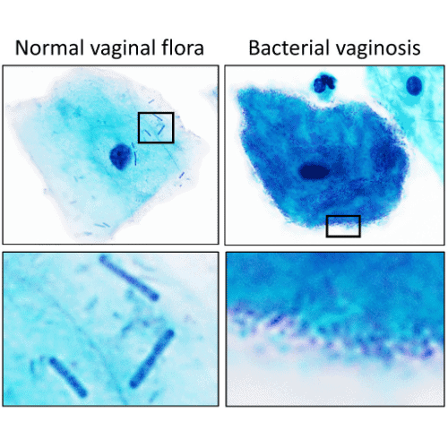 Bacterial Vaginosis Vs Normal Vaginal Flora